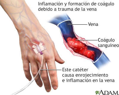 Si es posible beber la achicoria a la várice varicosa