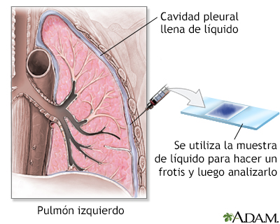 LIQUIDO PLEURAL se presenta cuando el liquido se acumula alrededor de los pulmones. la cavidad pleural contiene normalmente m